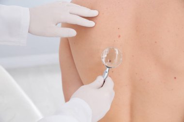 Dermatolog, klinikte büyüteçle hastanın doğum lekesini inceliyor.