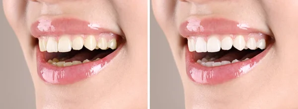 Lächelnde Junge Frau Vor Und Nach Der Zahnaufhellung Nahaufnahme — Stockfoto