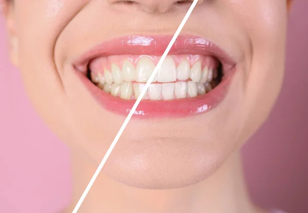 Mujer Joven Sonriente Antes Después Del Procedimiento Blanqueamiento Dientes Fondo — Foto de Stock