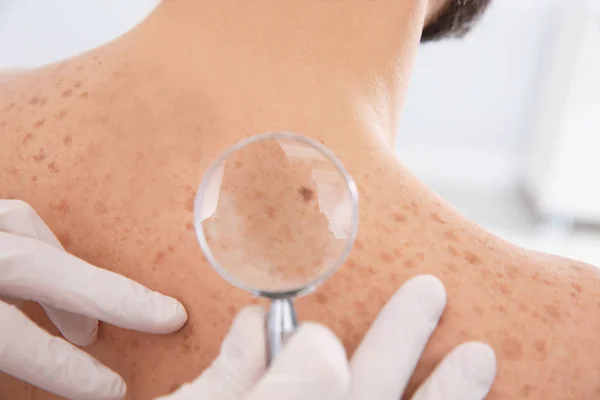 Dermatologist Examining Patient Birthmark Magnifying Glass Clinic Closeup — Stock Photo, Image