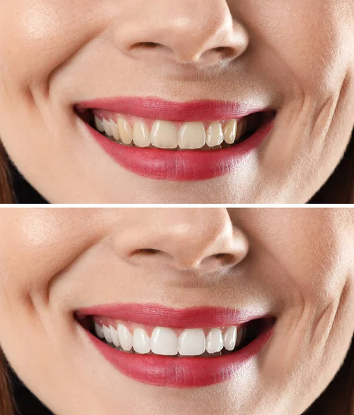 Χαμογελαστό Γυναίκα Πριν Και Μετά Λεύκανση Δοντιών Διαδικασία Κοντινό Πλάνο — Φωτογραφία Αρχείου