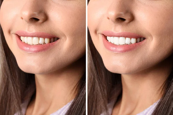 Mujer Sonriente Antes Después Del Procedimiento Blanqueamiento Dientes Primer Plano — Foto de Stock