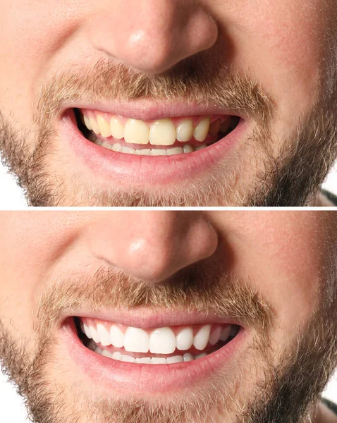 Uśmiechnięty Mężczyzna Przed Teeth Whitening Procedury Zbliżenie — Zdjęcie stockowe