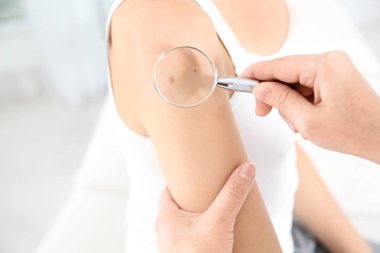 Dermatolog, klinikte büyüteçle hastanın doğum lekesini inceliyor.
