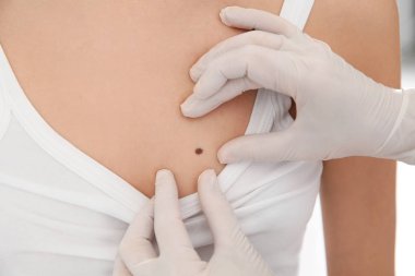 Dermatolog klinikte hastanın doğum lekesini inceliyor.