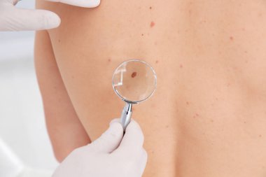 Dermatolog, klinikte büyüteçle hastanın doğum lekesini inceliyor.