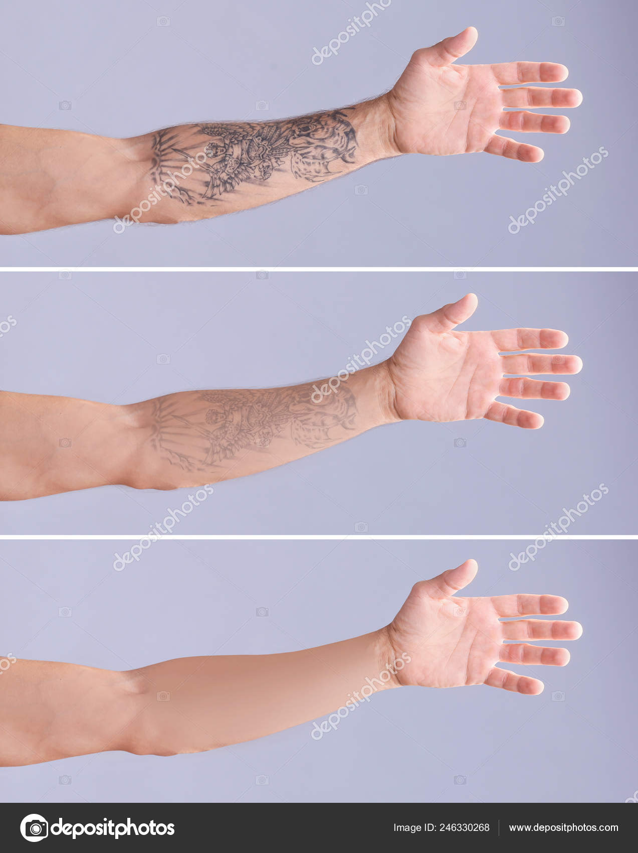 Marty Byars hand before laser removal treatment at the office of A Doors  Open a laser tattoo removal treatment nonprofit that specializes in  reentry for ex offenders on Sunday Dec 11 2016  