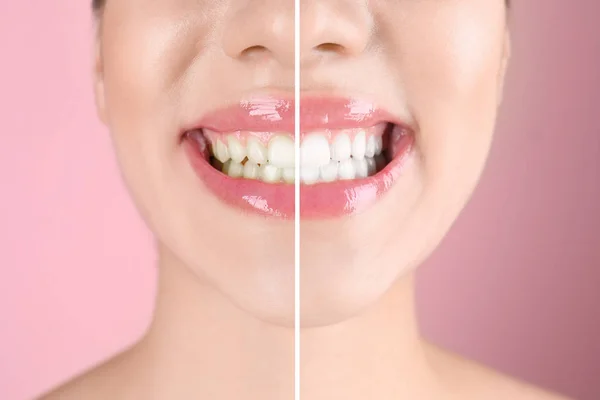 Mujer Joven Sonriente Antes Después Del Procedimiento Blanqueamiento Dientes Fondo — Foto de Stock