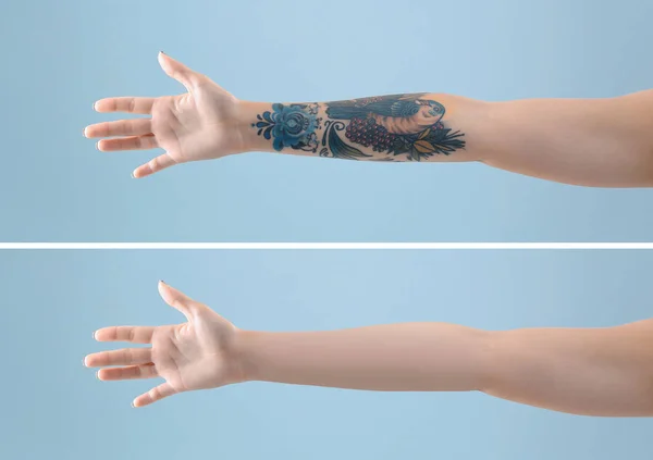 Νεαρή Γυναίκα Πριν Και Μετά Διαδικασία Αφαίρεσης Τατουάζ Λέιζερ Έγχρωμο — Φωτογραφία Αρχείου