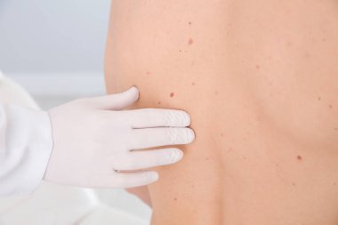 Dermatolog klinikte hastanın doğum lekesini inceliyor.