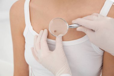 Dermatolog, klinikte büyüteçle hastanın doğum lekesini inceliyor.