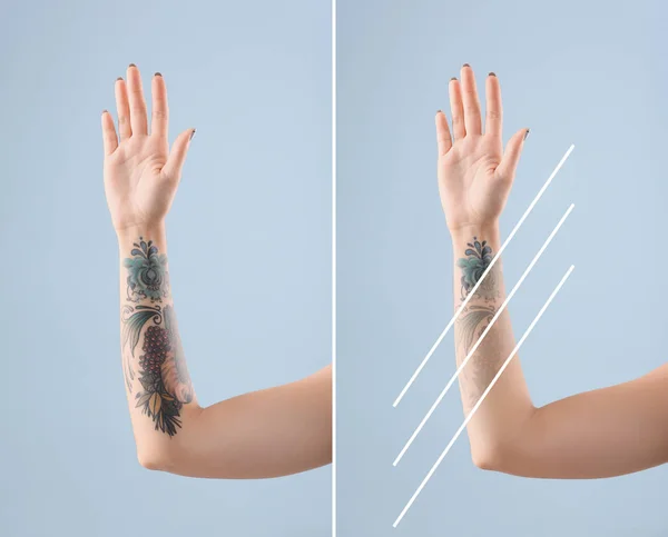 Nuori Nainen Ennen Jälkeen Laser Tatuointi Poisto Menettely Värillinen Tausta — kuvapankkivalokuva