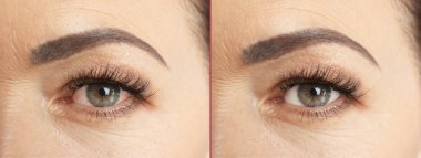 Olgun kadın önce ve sonra alerji tedavisi, portre. Kırmızı göz