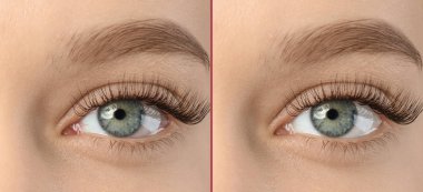 Genç kadın önce ve sonra alerji tedavisi, portre. Kırmızı göz