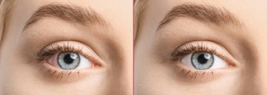 Genç kadın önce ve sonra alerji tedavisi, portre. Kırmızı göz