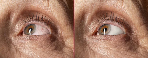 Mulher idosa antes e depois do tratamento da alergia, close-up. Olho vermelho — Fotografia de Stock