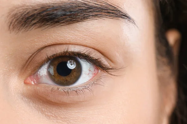 Young woman suffering from allergy, closeup. Red eye