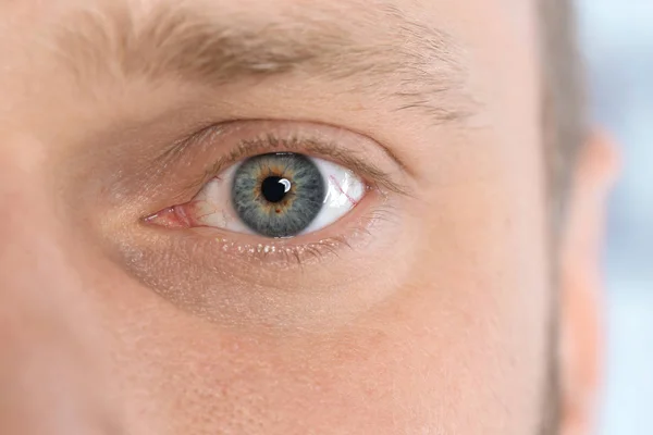 Młody człowiek cierpi na alergię, zbliżenie. Efektu czerwonych oczu — Zdjęcie stockowe