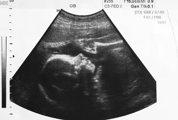 未出生婴儿在母亲子宫的超声照片, 特写镜头 — 图库照片