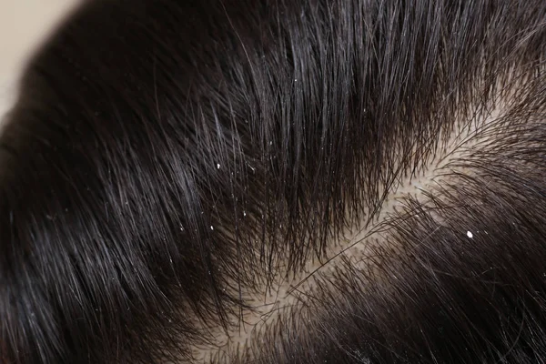 Γυναίκα με πιτυρίδα στα σκούρα μαλλιά της, κοντινή θέα — Φωτογραφία Αρχείου