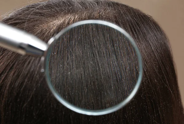 Closeup of woman with dandruff in her hair, view through magnifying glass — Stock Photo, Image