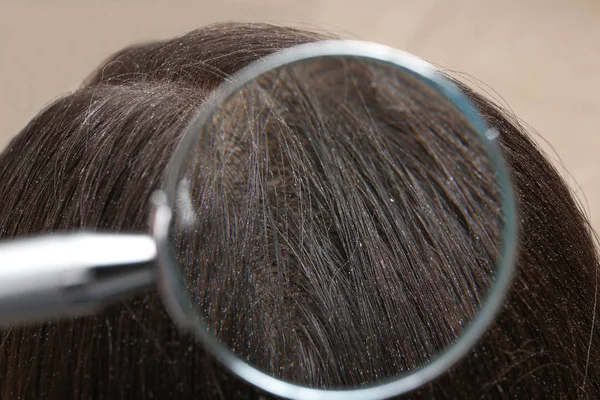 Крупный план женщины с перхоти в волосах, вид через увеличительное стекло — стоковое фото