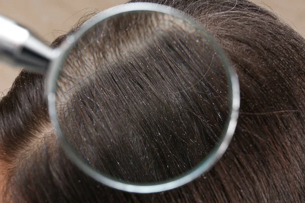 Detailní záběr ženy s lupy ve vlasech, pohled přes lupu — Stock fotografie