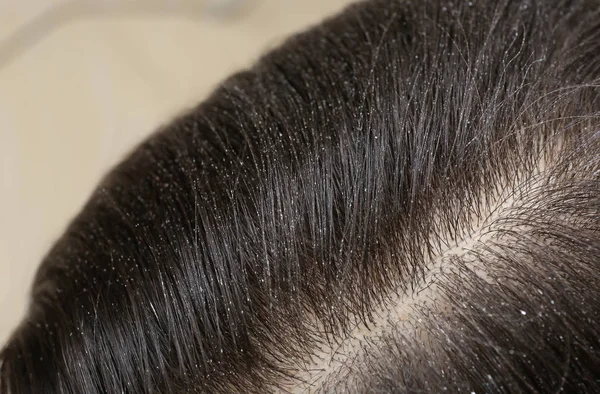 Mulher com caspa em seu cabelo escuro, vista close-up — Fotografia de Stock