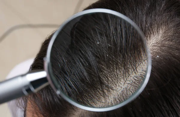 Крупним планом жінка з лупою в її волоссі, вид через збільшувальне скло — стокове фото