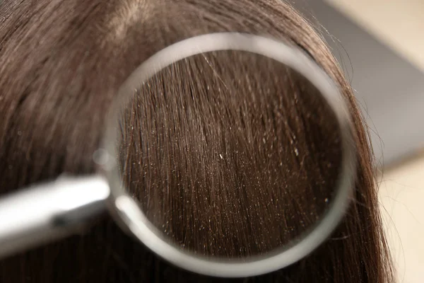 Closeup of woman with dandruff in her hair, view through magnifying glass — Stock Photo, Image