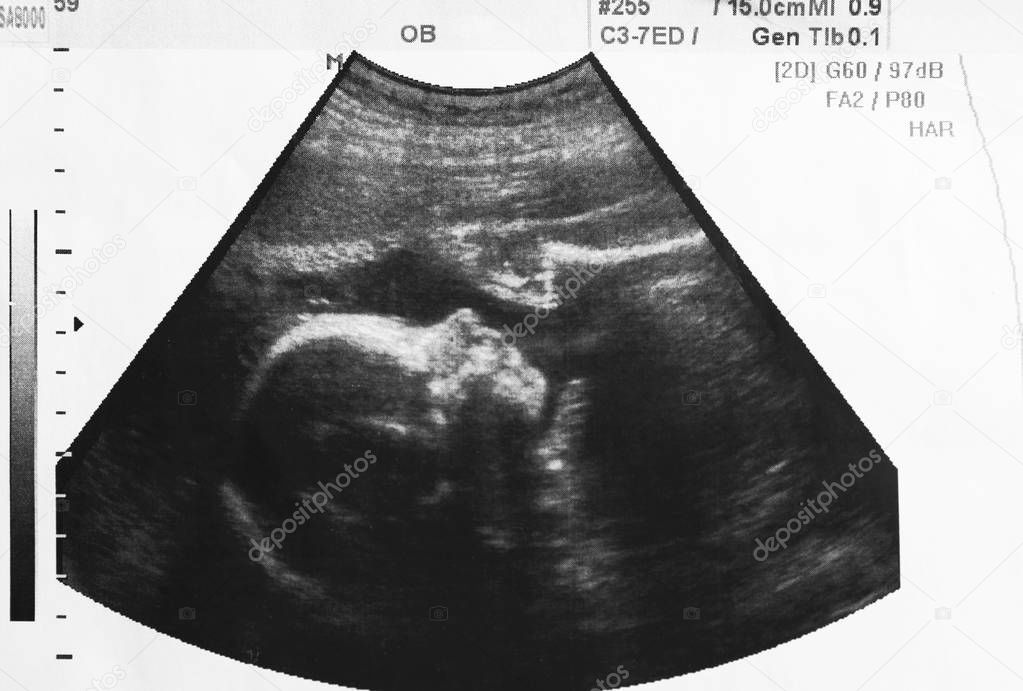 Ultrasound photo of unborn baby in mother's womb, closeup view