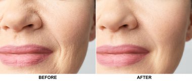 Olgun kadın önce ve sonra biorevitalization yordam, portre. Kozmetik cerrahi