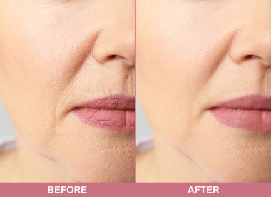 Olgun kadın önce ve sonra biorevitalization yordam, portre. Kozmetik cerrahi