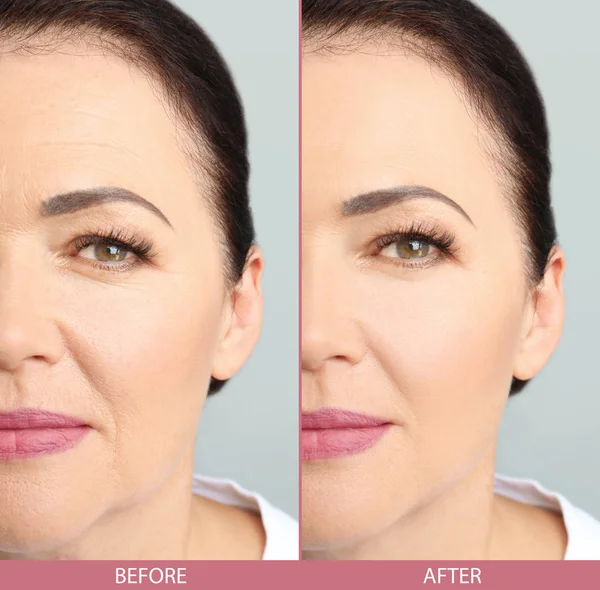 Mature woman before and after biorevitalization procedure, closeup. Cosmetic surgery