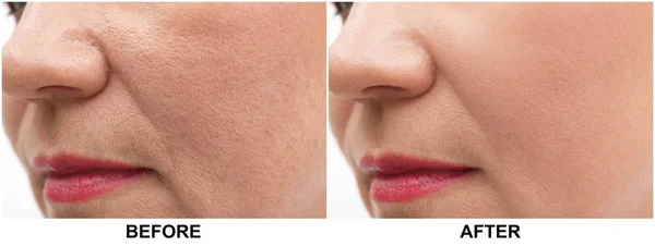 Wanita dewasa sebelum dan sesudah prosedur biorevitalisasi, closeup. Operasi kosmetik — Stok Foto