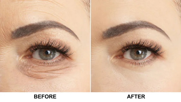 Zralá žena před a po zákroku operace očních víček, closeup. Kosmetická chirurgie — Stock fotografie