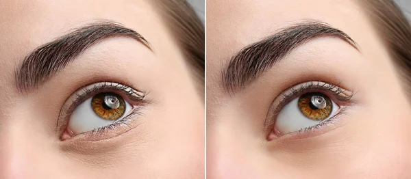 Kvinna före och efter Ögonlocksplastik förfarande, närbild. Kosmetisk kirurgi — Stockfoto