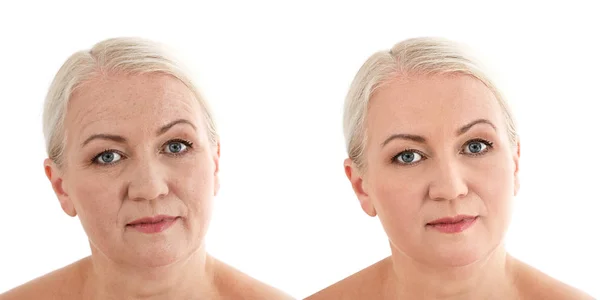 Rijpe vrouw voor en na biorevitalization procedure op witte achtergrond. Cosmetische chirurgie — Stockfoto