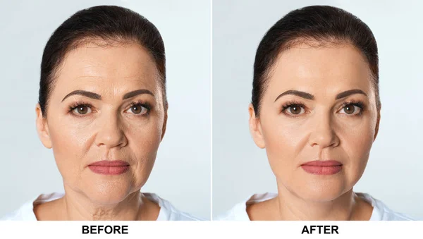 Wanita dewasa sebelum dan sesudah prosedur biorevitalisasi pada latar belakang cahaya. Operasi kosmetik — Stok Foto