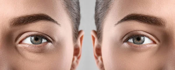 Frau vor und nach der Blepharoplastik, Nahaufnahme. Schönheitschirurgie — Stockfoto