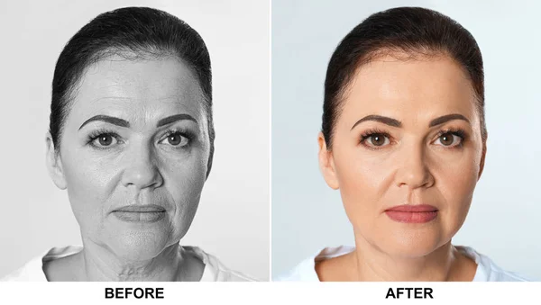 Wanita dewasa sebelum dan sesudah prosedur biorevitalisasi pada latar belakang cahaya. Operasi kosmetik — Stok Foto
