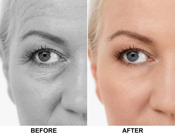 Зрелая женщина до и после блефаропластики, крупным планом. Косметическая хирургия — стоковое фото