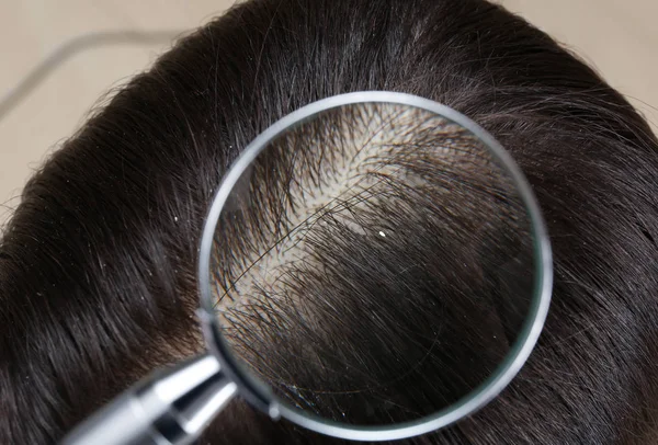 Close-up de mulher com caspa no cabelo, vista através de lupa — Fotografia de Stock