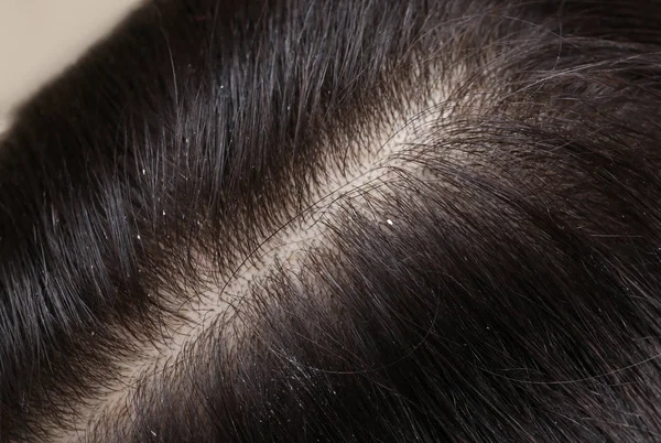 Mulher com caspa em seu cabelo escuro, vista close-up — Fotografia de Stock