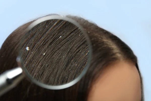 Closeup of woman with dandruff in her hair on color background, view through magnifying glass — Stock Photo, Image