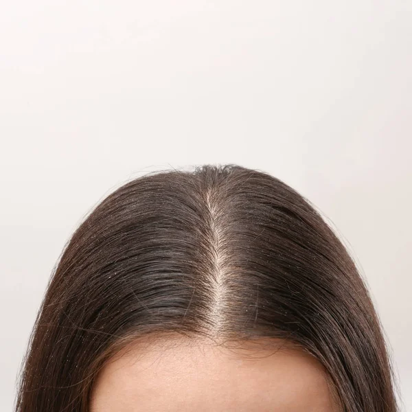 Mujer con caspa en su cabello oscuro sobre fondo claro, vista de cerca. Espacio para texto — Foto de Stock