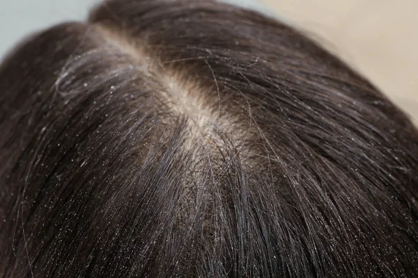 Mulher com caspa em seu cabelo escuro, vista close-up — Fotografia de Stock