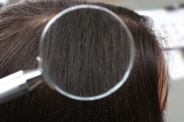 Closeup of woman with dandruff in her hair, view through magnifying glass — Stock Photo, Image