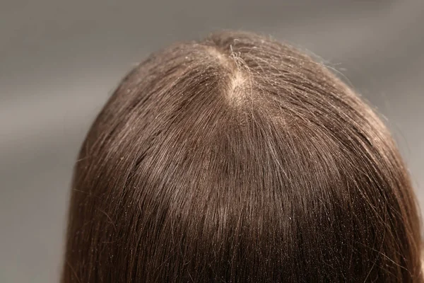 Γυναίκα με πιτυρίδα στα σκούρα μαλλιά της σε γκρι φόντο, κοντινό πλάνο — Φωτογραφία Αρχείου