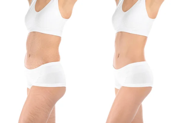 Mulher antes e depois da operação plástica no fundo branco. Conceito de cuidado corporal — Fotografia de Stock